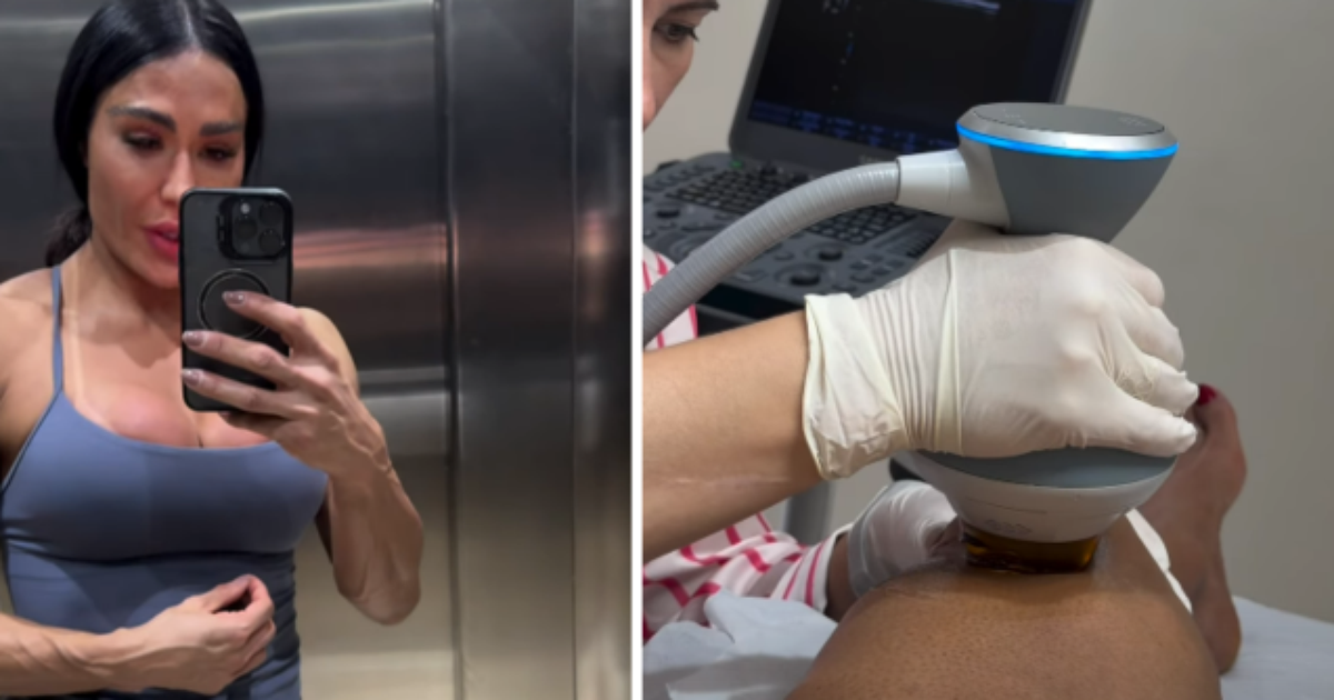 Gracyanne Barbosa recorre a punção para retirar líquido do joelho devido à 'Dança dos Famosos'