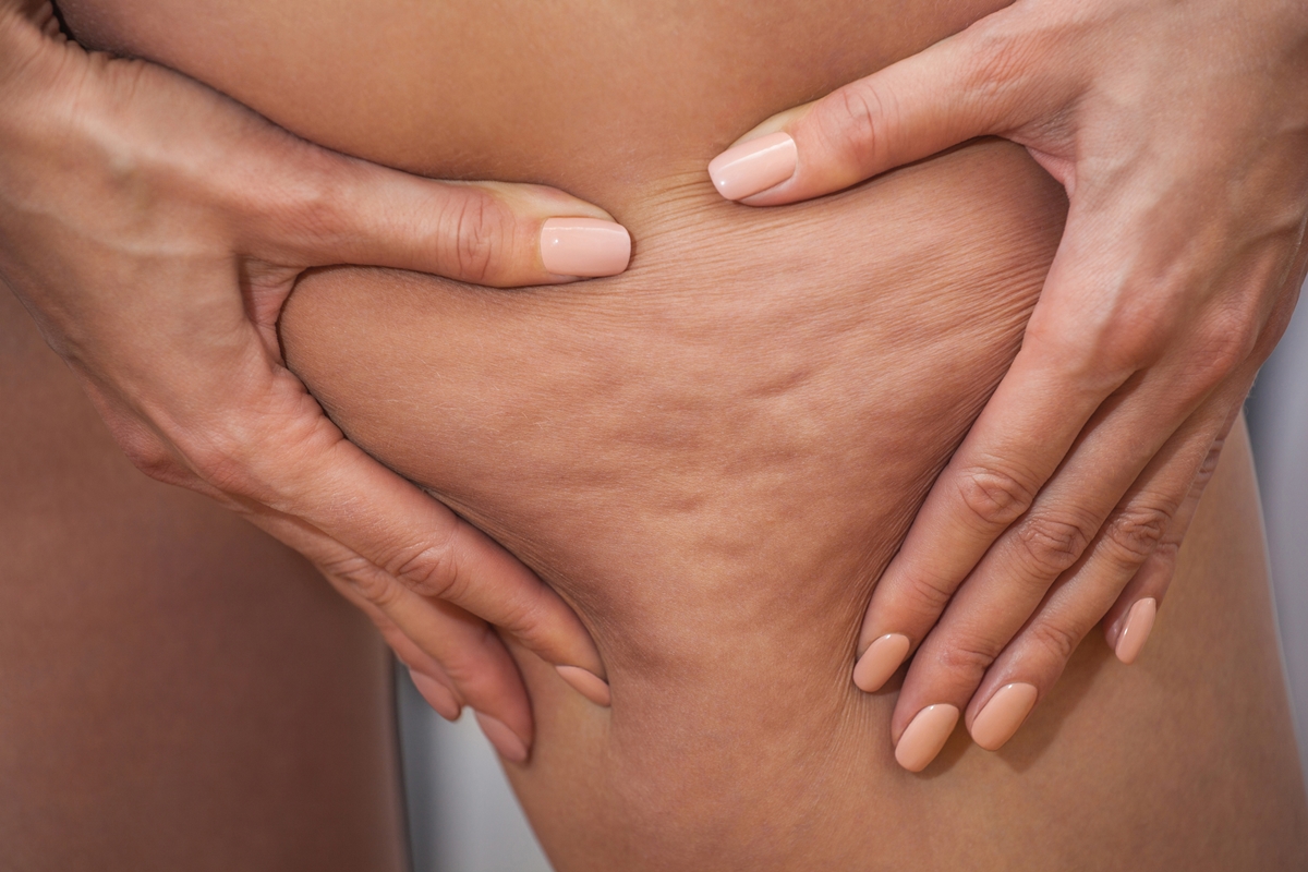 Dry brushing: prática de escovar celulites não tem comprovação científica